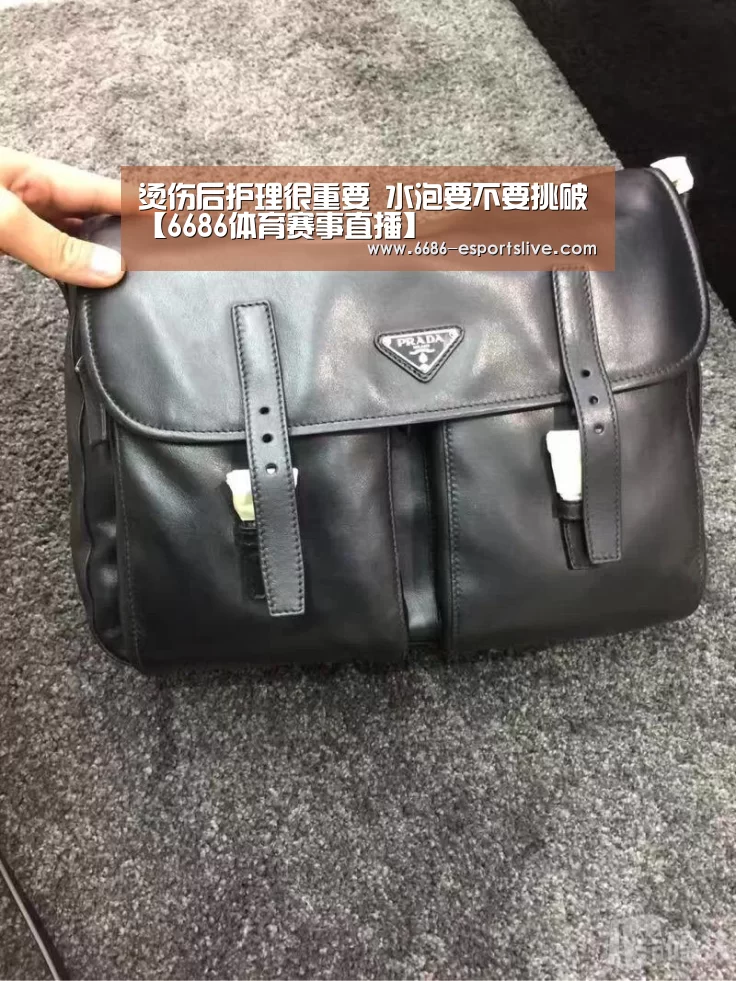 烫伤后护理很重要 水泡要不要挑破【6686体育赛事直播】(图2) 6686电竞竞猜